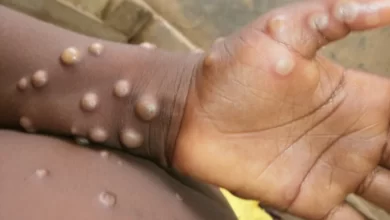 Worry, Fear As Monkeypox Spreads In Kwazulu-Natal 3
