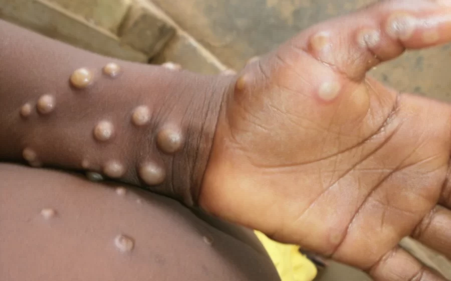 Worry, Fear As Monkeypox Spreads In Kwazulu-Natal 5