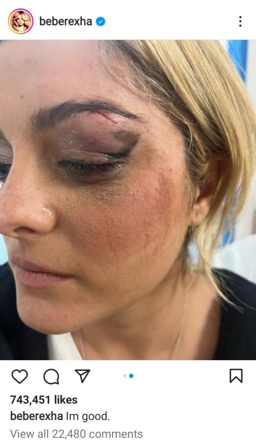 Bebe Rexha Attacked On Stage, Left With Injuries On The Face 2